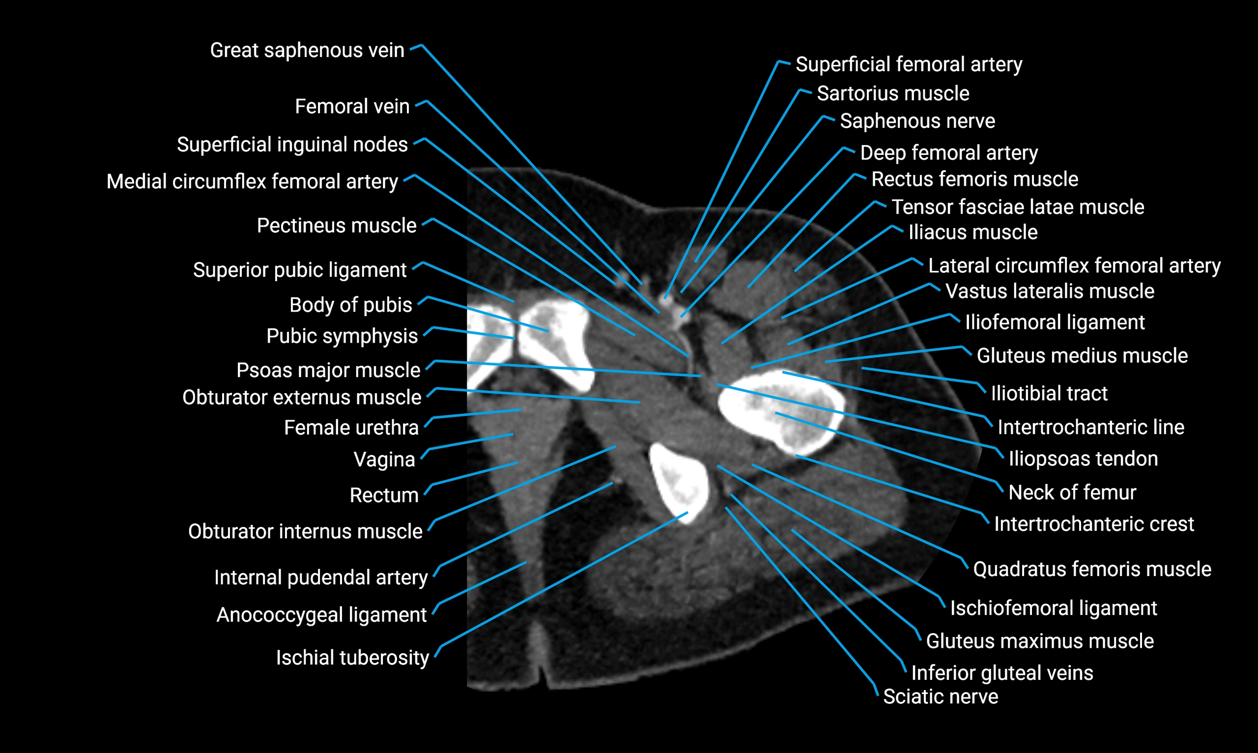 CT lower limb axial cross sectional anatomy labelled image 13 (1).webp